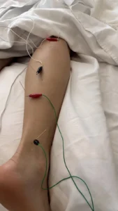 Acupuncture for plantar fasciitis | Julie Nelson Acupuncture
